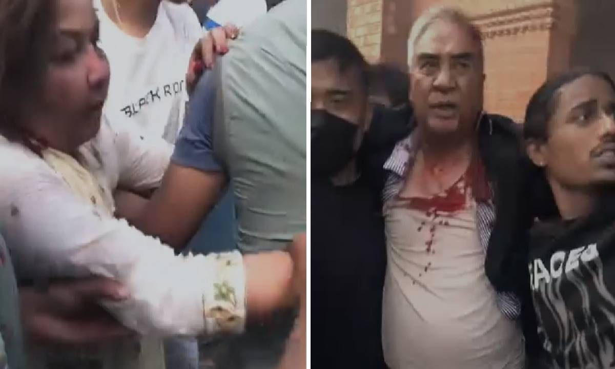 देउवाको टाउकोमा १२ टाँका लगाइयो, बोलचाल र हिँडडुल गर्न सक्ने