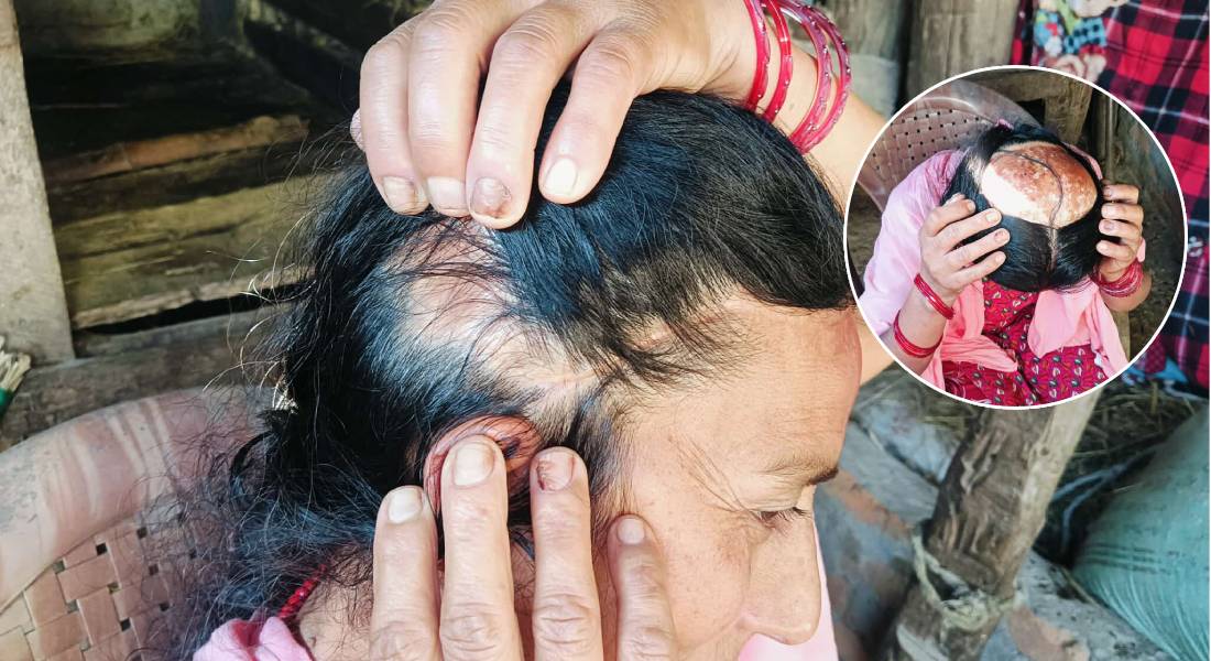 २३ वर्षदेखि भालुले लुछेको चोट बोकेकी पवित्राको वेदना- मान्छेको भन्दा जनावरको मोल बढी भयो !